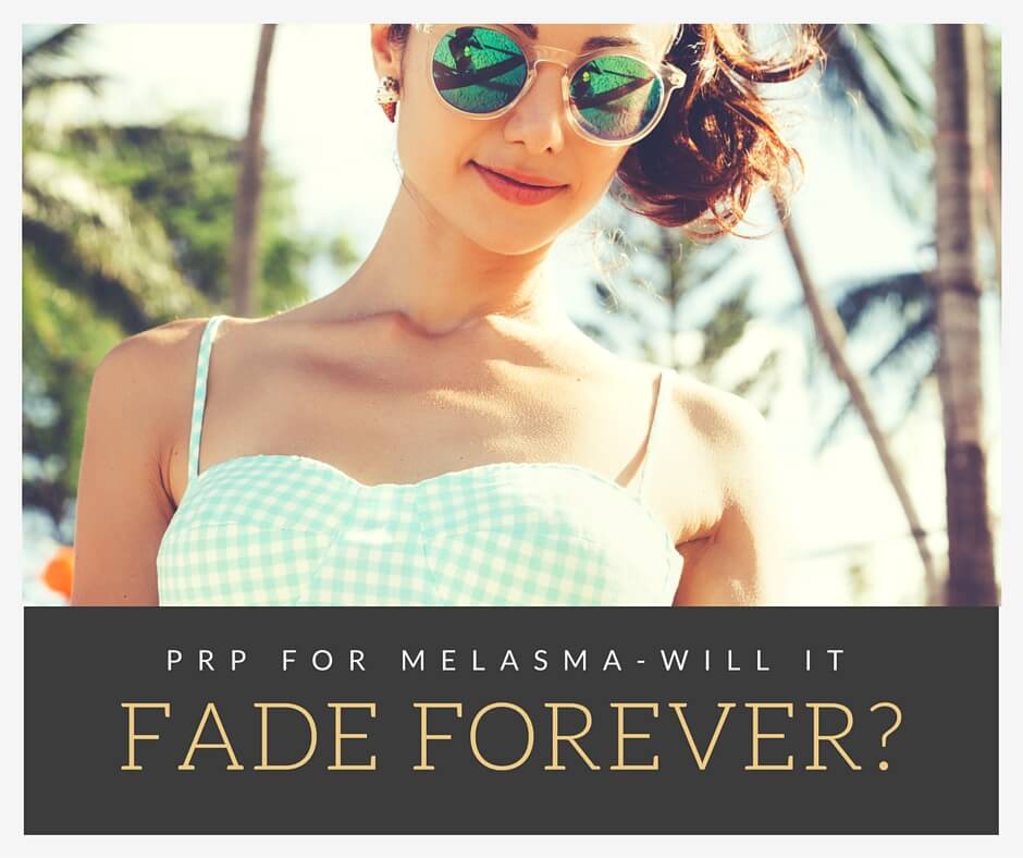 Platelet-Rich Plasma For Melasma — Will It Fade Forever?