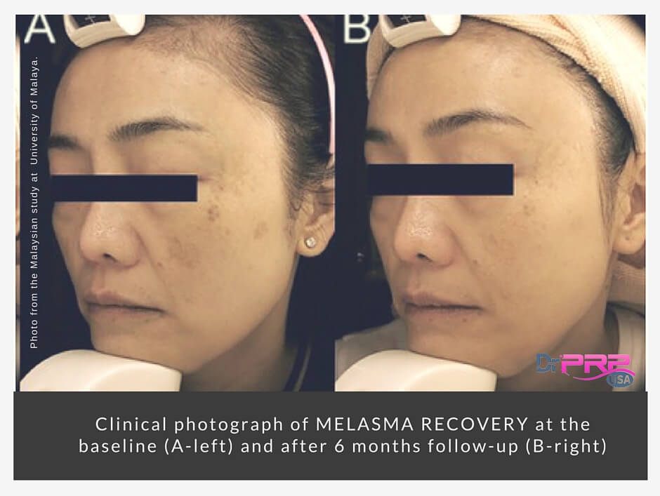 Platelet-Rich Plasma For Melasma — Will It Fade Forever?