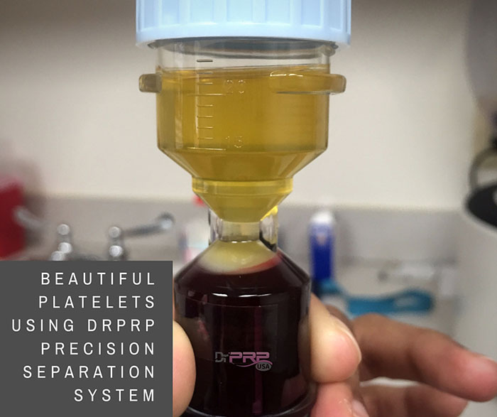 Platelets Separated using DrPRP USA PRP Separation Kit