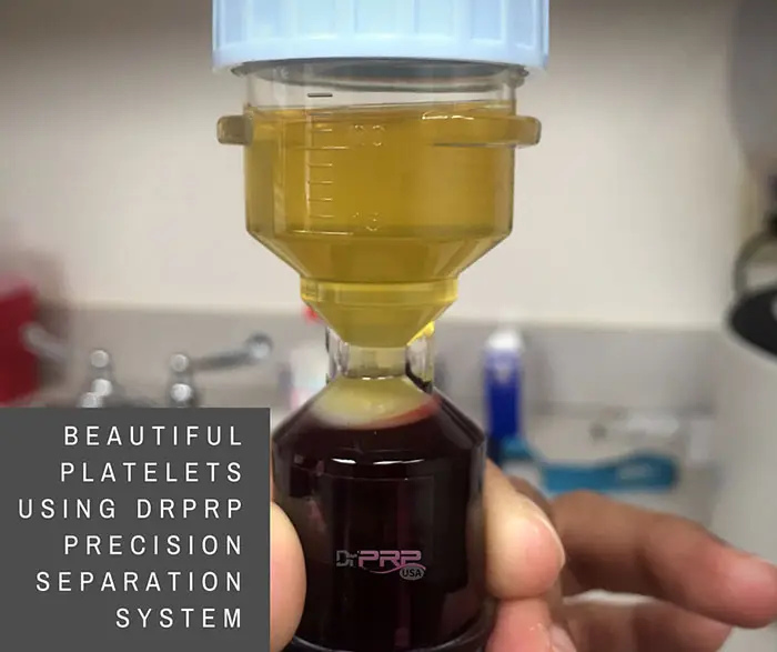 Platelets Separated using Dr. PRP USA PRP Separation Kit