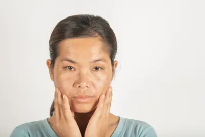PRP for Melasma