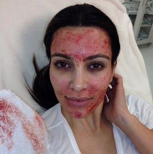 Kim Kardashian PRP Injection