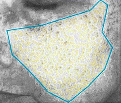 After 4 weeks: 271 UV spots