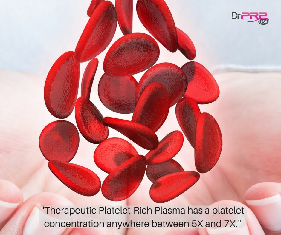 Therapeutic PRP has platelet concentration between 5X and 7X