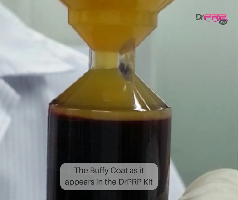 Buffy coat as it apperas in Dr. PRP USA PRP Kit
