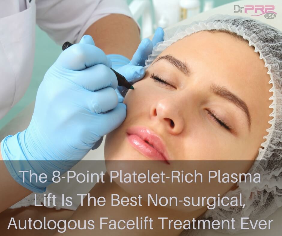 The 8-Point Platelet Rich Plasma Lift is the Best Non-Surgical Autologous Facelift Treatment Ever