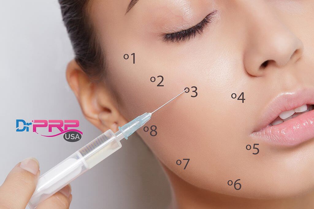 PRP Injection Spots