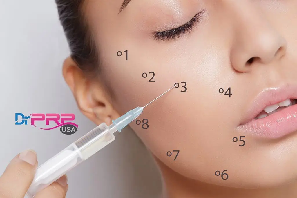 PRP Injection Spots