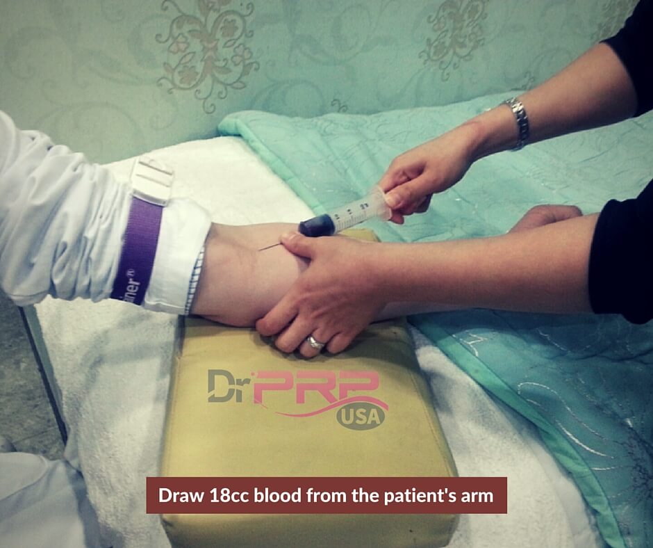 PRP specialist drawing 18cc of Blood from Patient's Arm