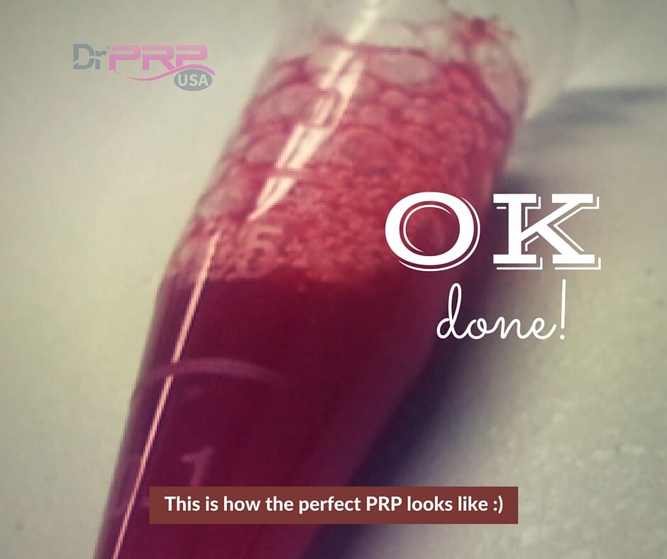 Successful PRP Preparation Procedure Using the DrPRP PRP Kit and Centrifuge