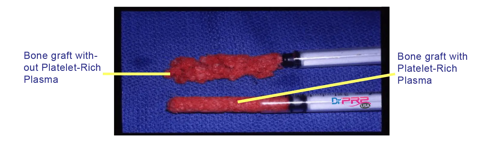 Foot And Ankle Surgeon’s Guide To Platelet-Rich Plasma